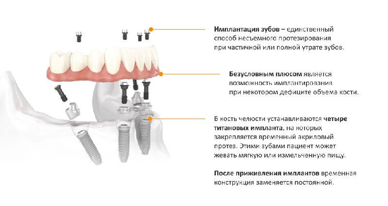 несъемный протез на имплантах