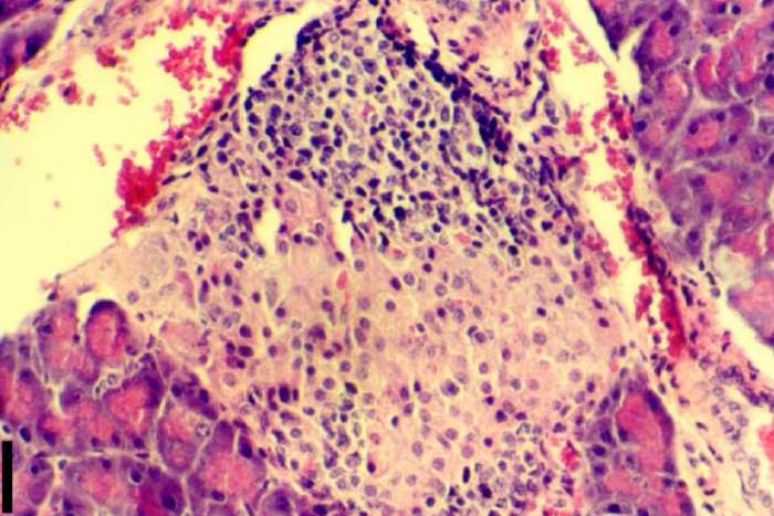 Панкреатический островок, поражённый аутоиммунным инсулитом — группы бета-клеток замещены соединительной тканью.
