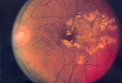 Пролиферативная диабетическая ретинопатия, следы от лазерной фотокоагулиции в области макулы, флюоресцентная ангиография.